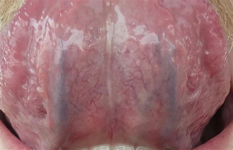 is this normal? 🤔 bottom of my tongue...3 veins? : r/askdentists