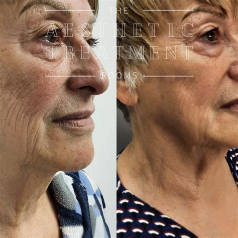 Mesotherapy | Karisma | Collagen — The Aesthetic Treatment Rooms