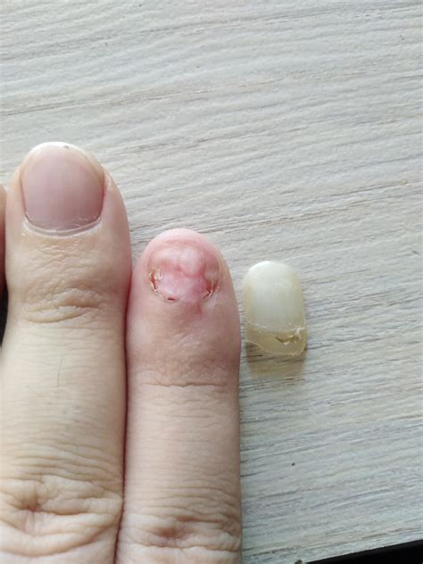 What To Do When You Rip Your Nail Bed at Nicholas Barrallier blog