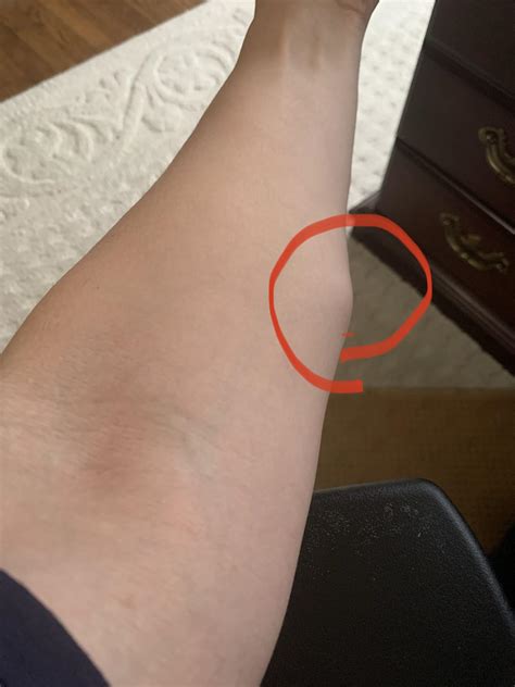 Painful Lump On Underside Of Forearm at Luis Manson blog