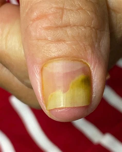 how to get rid of green nails after false nails