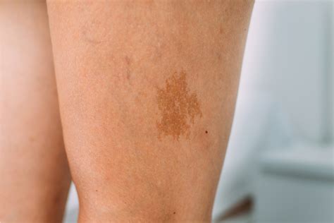 types  birthmarks infantile hemangiomas  strawberry baby