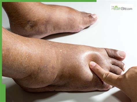 swollen feet   diseases   lead  severe feet
