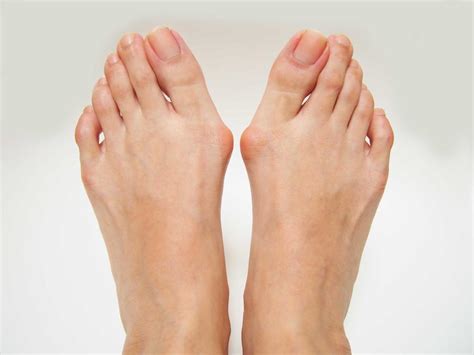 Common Causes of Bunions: North Central Texas Foot & Ankle: Board ...