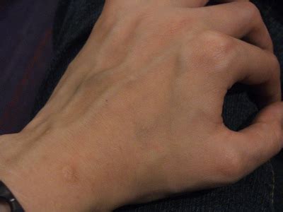 Diagnosing EDS-Examine new Nosology and Diagnostic Criteria