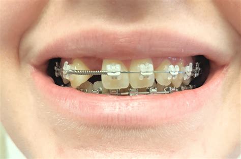 7 months in! Front teeth are off thanks to the coil but this should be