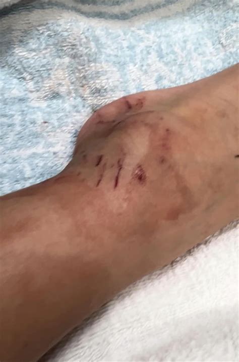Python bites and drags 5-year-old Australian boy into pool