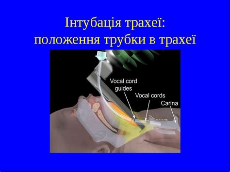 Методика інтубації трахеї - презентація з медицини