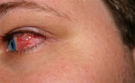 pink eye symptoms benaim eye