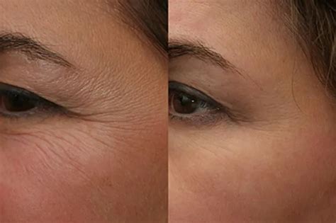 Tratamento Com Plasma No Rosto Valor - Tratamento com Plasma no rosto: Antes e depois – Antes da Fama