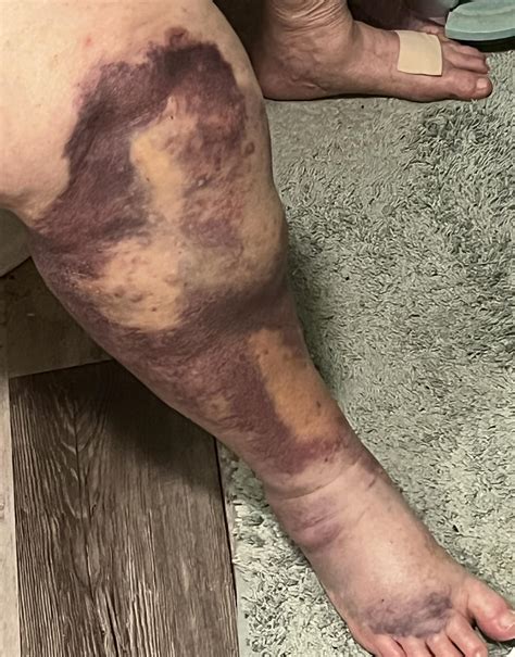 Medical folks. Any idea how to get the swelling to go down? It keeps