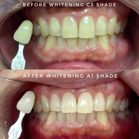 Smile Point Dental | Adelaide SA