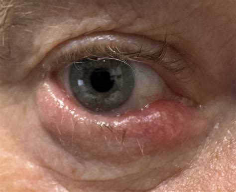 Blepharitis & Chalazions — Dr Christopher Stewart | Specialist