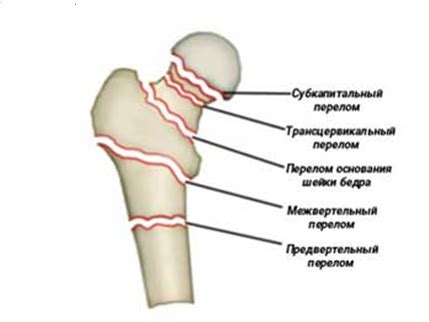 НАШИ БУДНИ: Успешное лечение пациентки с несросшимся переломом ...