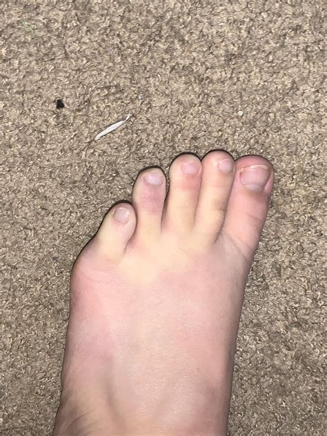 Unexplained “toe sores”/Raynaud’s : r/Raynauds