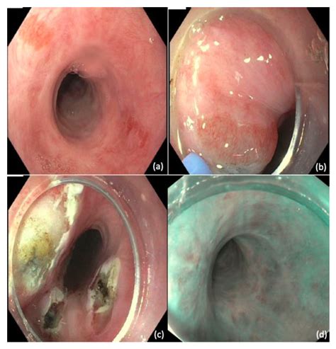 Esophagus Cancer
