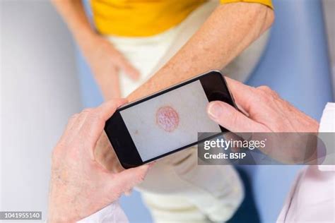 Psoriasis Skin Cells Photos and Premium High Res Pictures - Getty Images