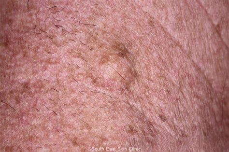 Sebaceous Cyst Infection