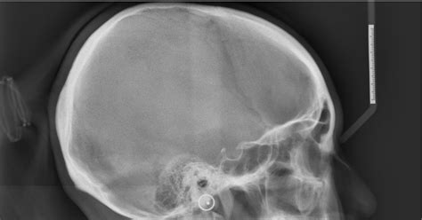 The Argumentative Me: Lateral Cephalogram.