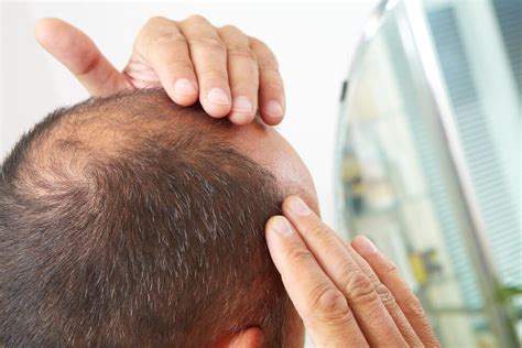 Hair Loss Treatment For Men - Richmond