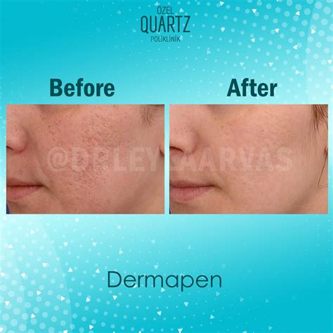 Dermapen - Price - Istanbul, Turkey - Op. Dr. Leyla Arvas