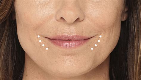 marionette lines treatments  clinic room theclinicroom