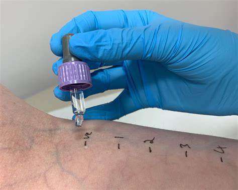 Skin Prick Allergy Test - The London Skin And Hair Clinic
