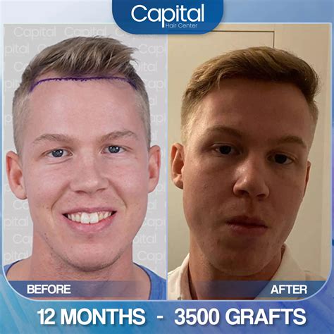 Graft Calculation - Capital Hair Transplant Turkey Dr. Ekrem Keskin