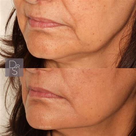 Effective Ways to Eliminate Chin Flab and Tone Your Jawline Quickly - Hunter Games Magazine