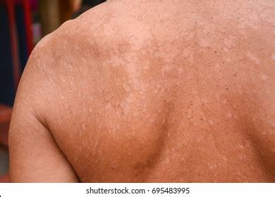 Tinea Versicolor Before And After