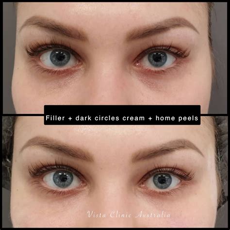 Eyes Dark Circles Before After