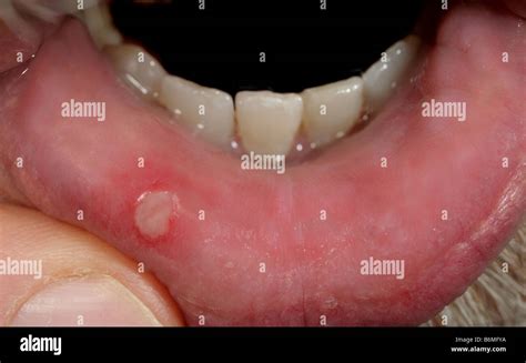 Oral Herpes Vs Aphthous Ulcer at Nancy Ramirez blog