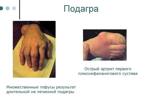 Лечение подагры - презентация онлайн