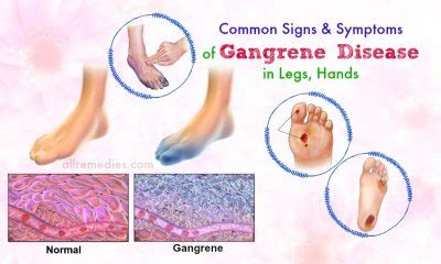 Top 6 Common Signs & Symptoms Of Gangrene Disease In Legs, Hands