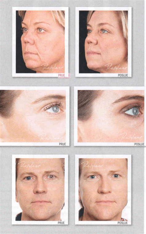 Revitalizacija kože - Restylane Vital i Vital light hijaluronska kiselina!