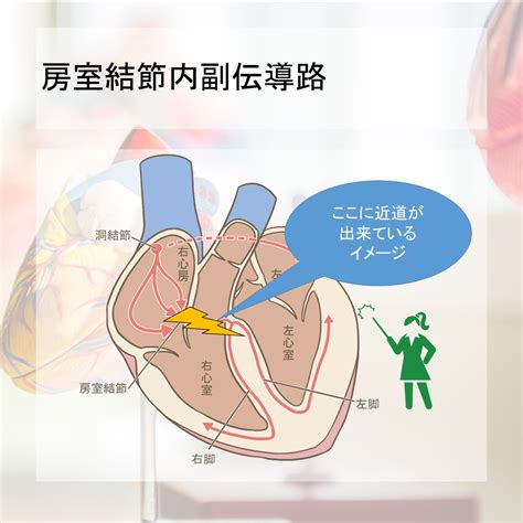 PQ短縮はWPW症候群だけじゃない！LGL症候群について簡単にわかりやすく解説します。 | ふかブロ