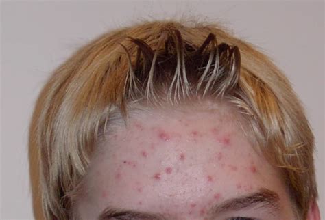 Pimple patches and how to apply them | Hombres con Estilo