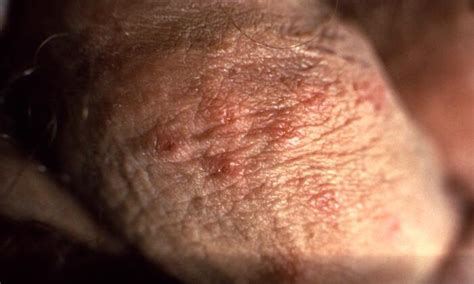 Herpes Simplex Type 2 - MD Searchlight