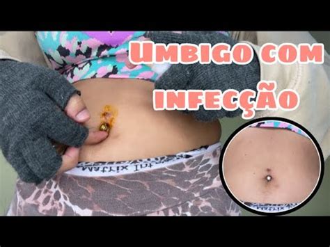 Umbigo Inflamado Em Adulto