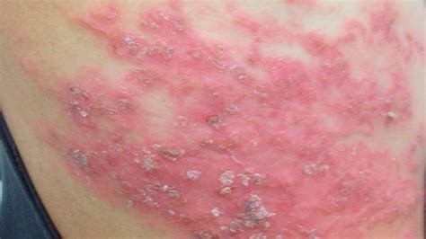Holes In Skin Disease