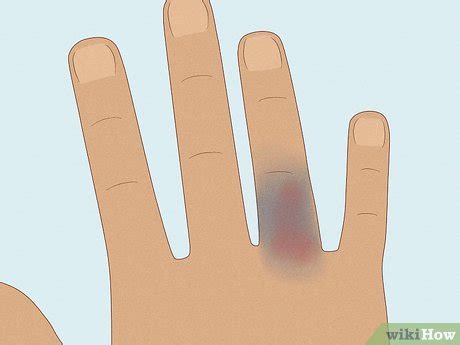 how to know if your knuckle is broken