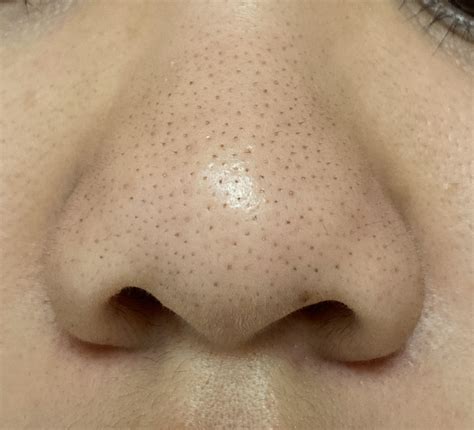402 best Blackheads images on Pholder | Skincare Addiction, Skincare