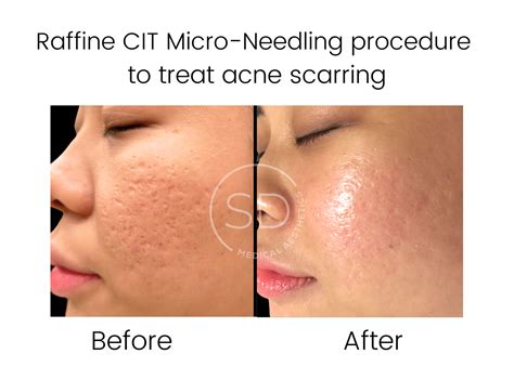 Raffine Micro-Needling Before and After Gallery — Skin Devices
