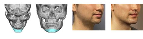 3D Accuscan Patient-Specific® - Implantech
