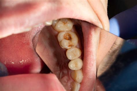Stages Of Dental Caries