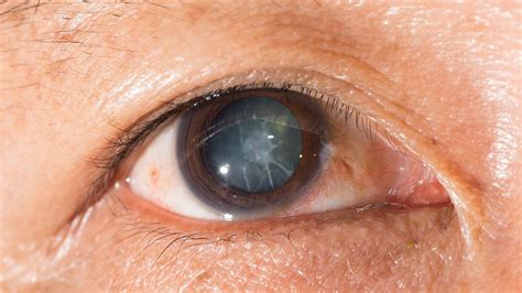 cortical cataract symptoms   treatment