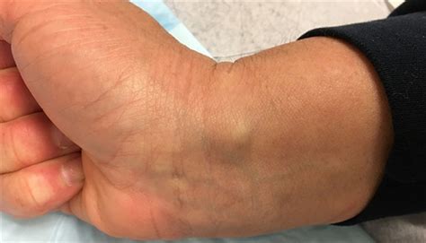 Ganglion Cyst Wrist