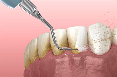 Tooth Scaling: Procedure, Benefits, Risks