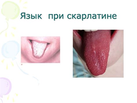 Корь. Краснуха. Ветряная оспа. Скарлатина - презентация онлайн