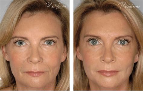 Dermal Fillers | Avenue MediSpa, Havant, Emsworth, Westbourne